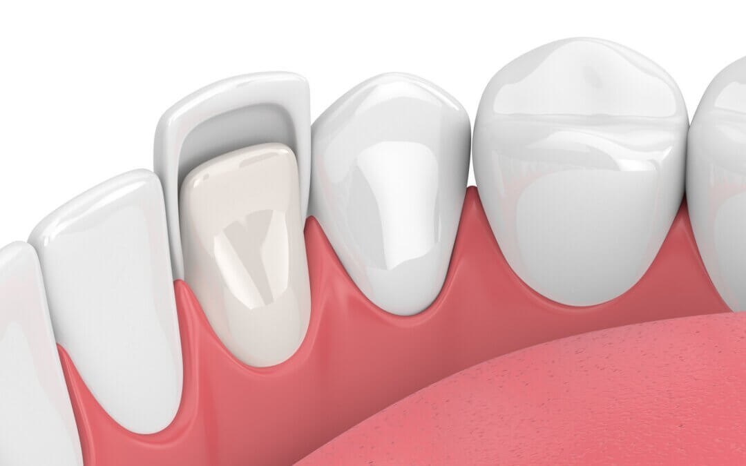 What Are The Differences Between Composite vs Porcelain Veneers?